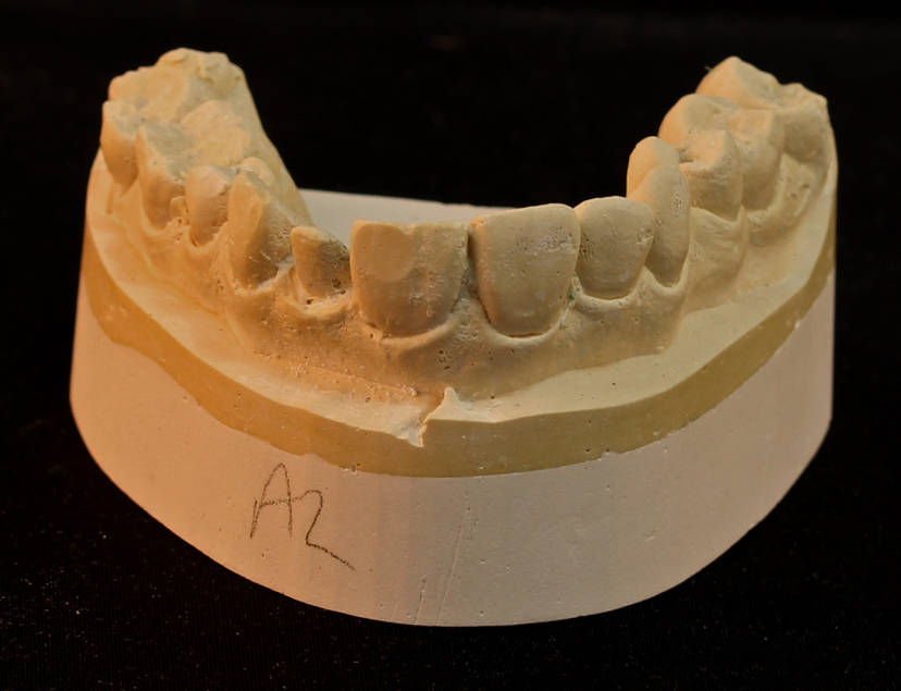 2-Creazione Calco Dentale del paziente